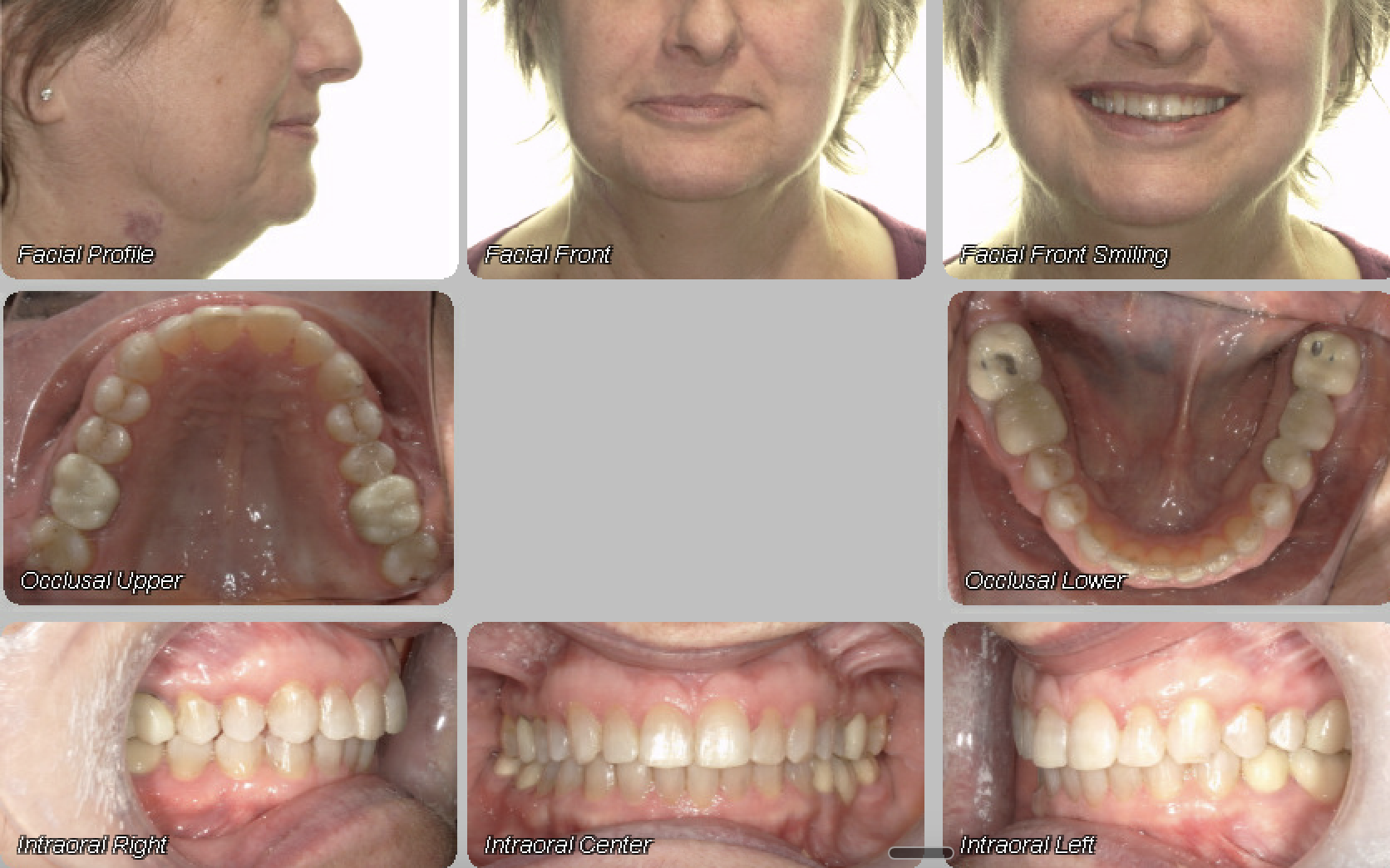 Case 11 — after treatment