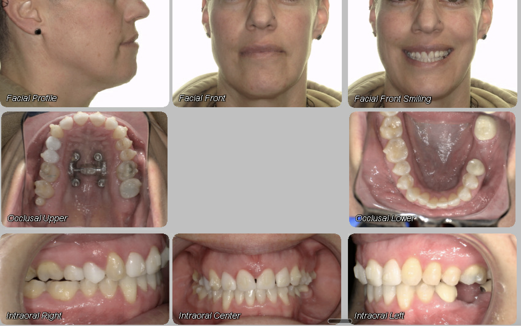 Case 13 — after treatment