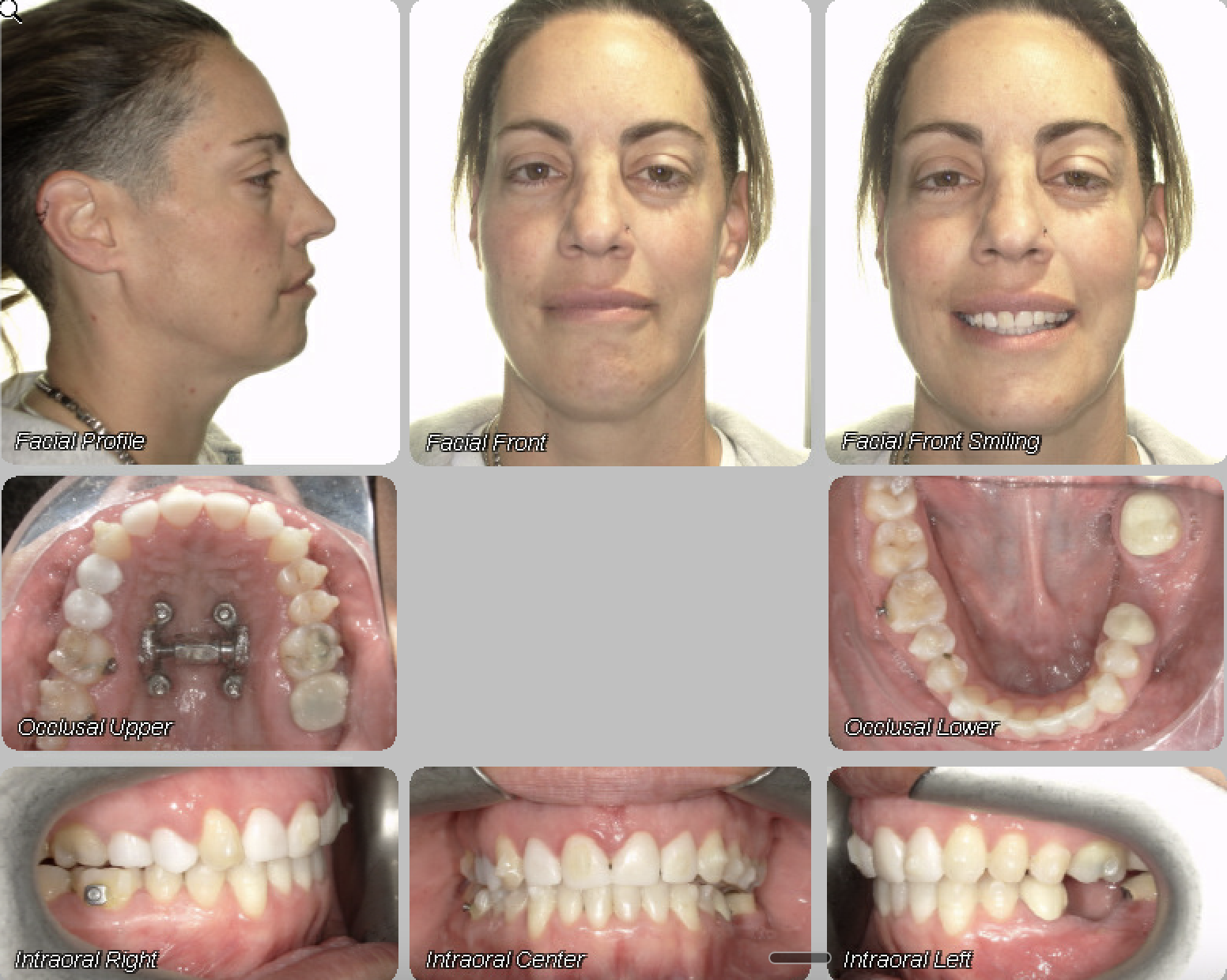 Case 13 — after treatment