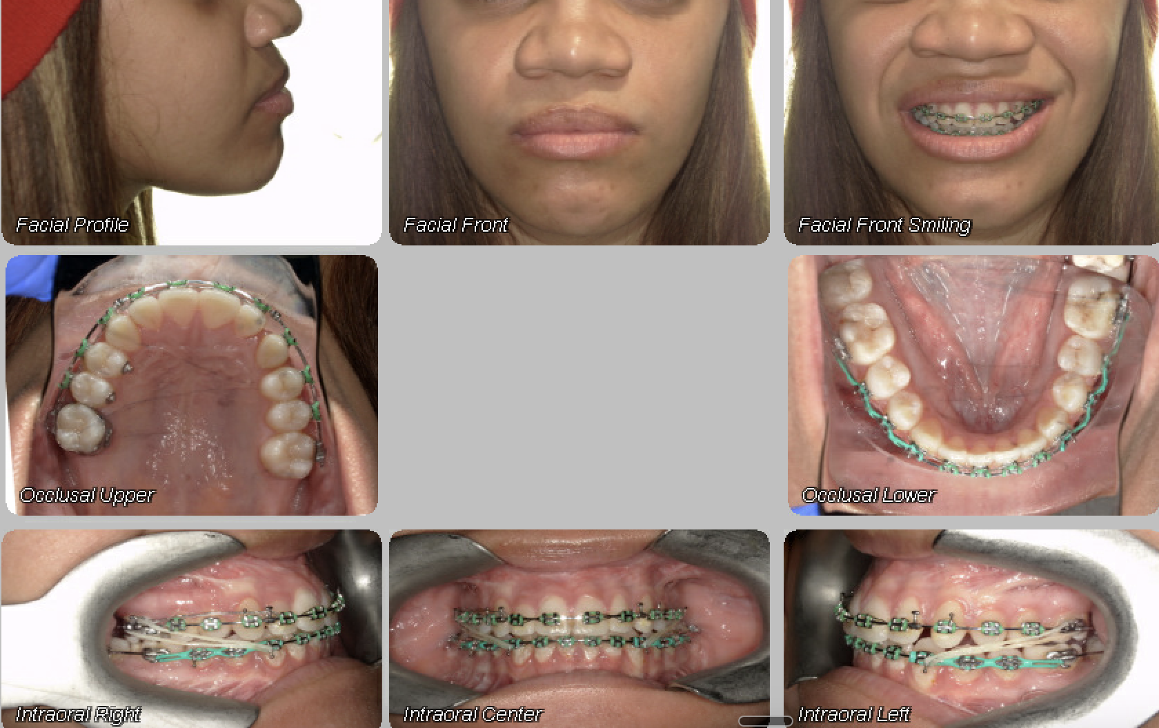 Case 14 — after treatment