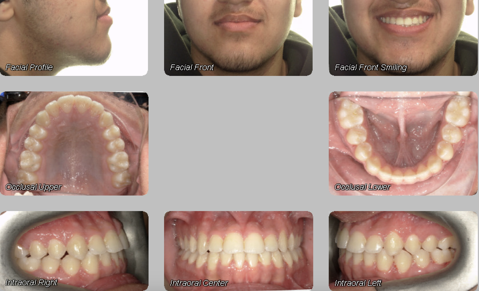 Case 03 — after treatment