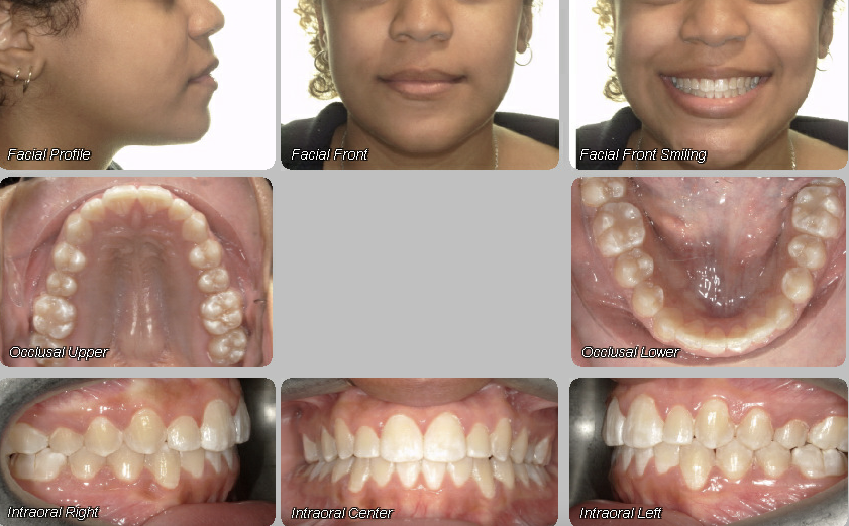 Case 04 — after treatment