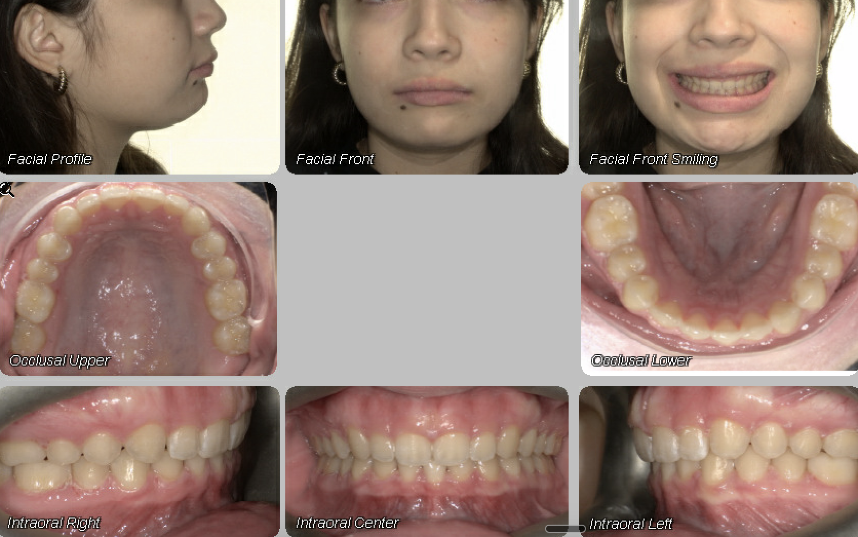 Case 05 — after treatment