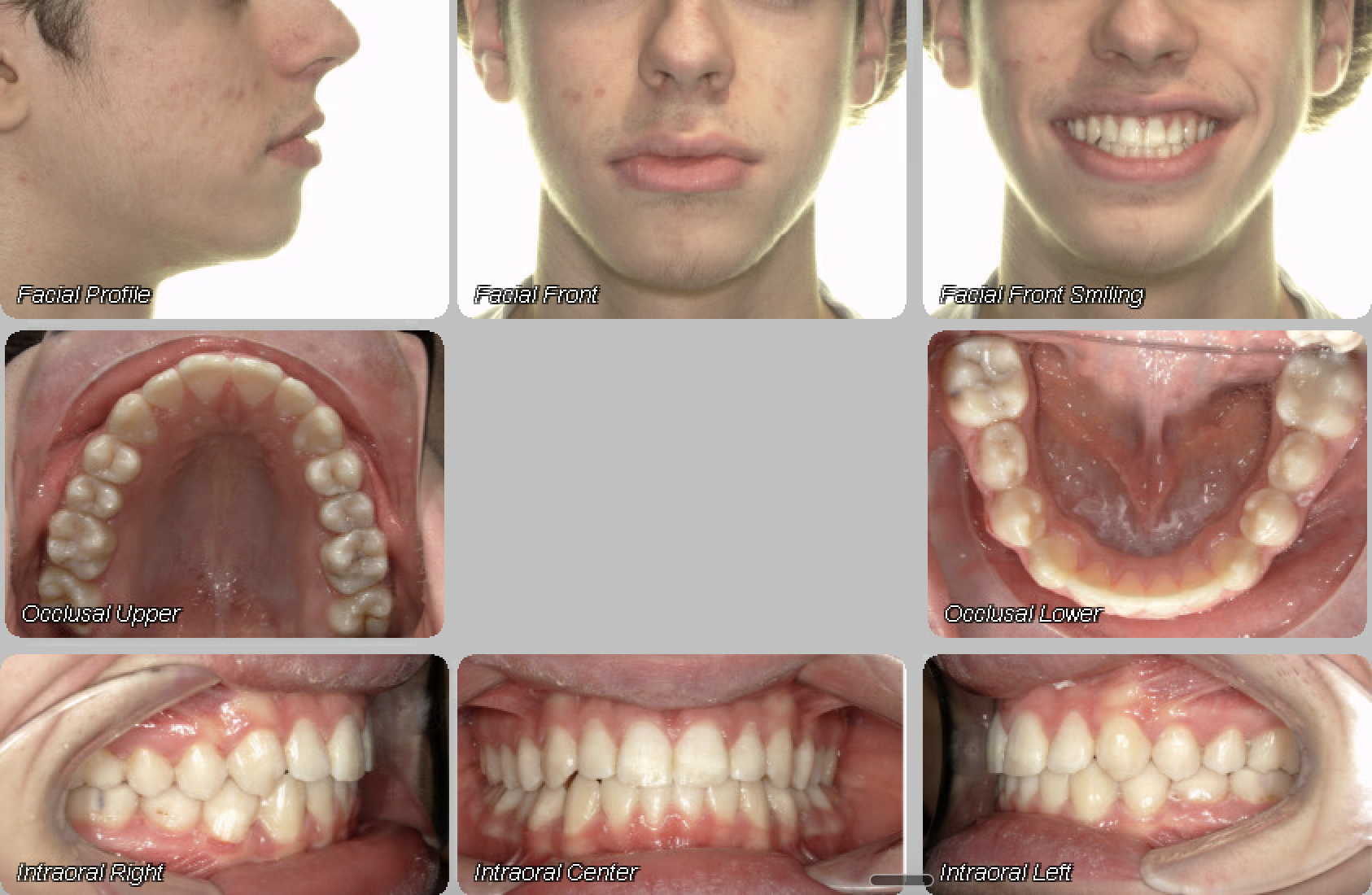 Case 06 — after treatment