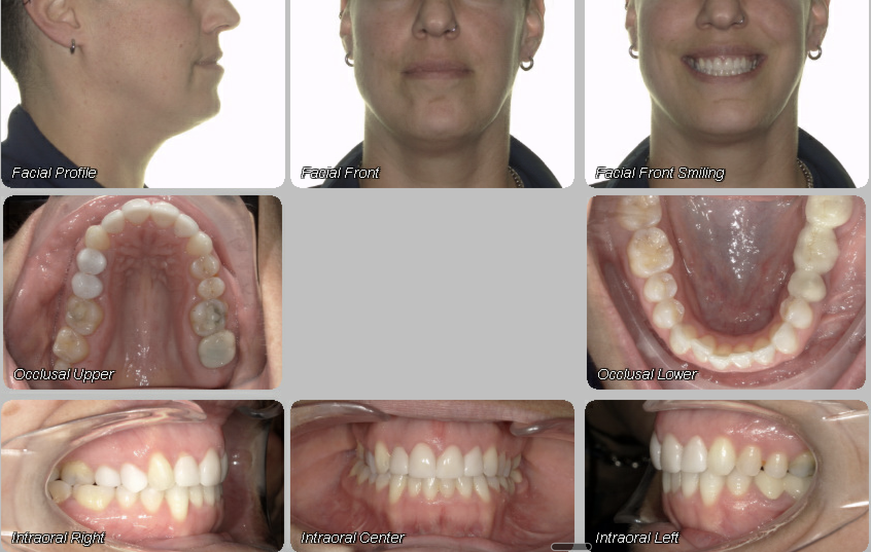 Case 13 — before treatment