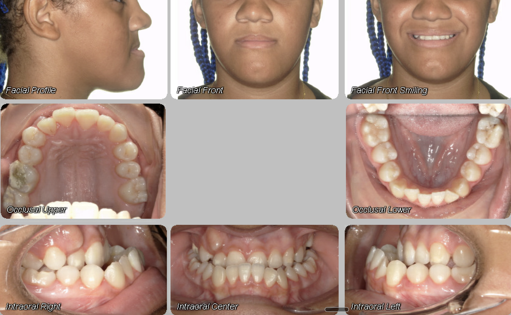 Case 14 — before treatment
