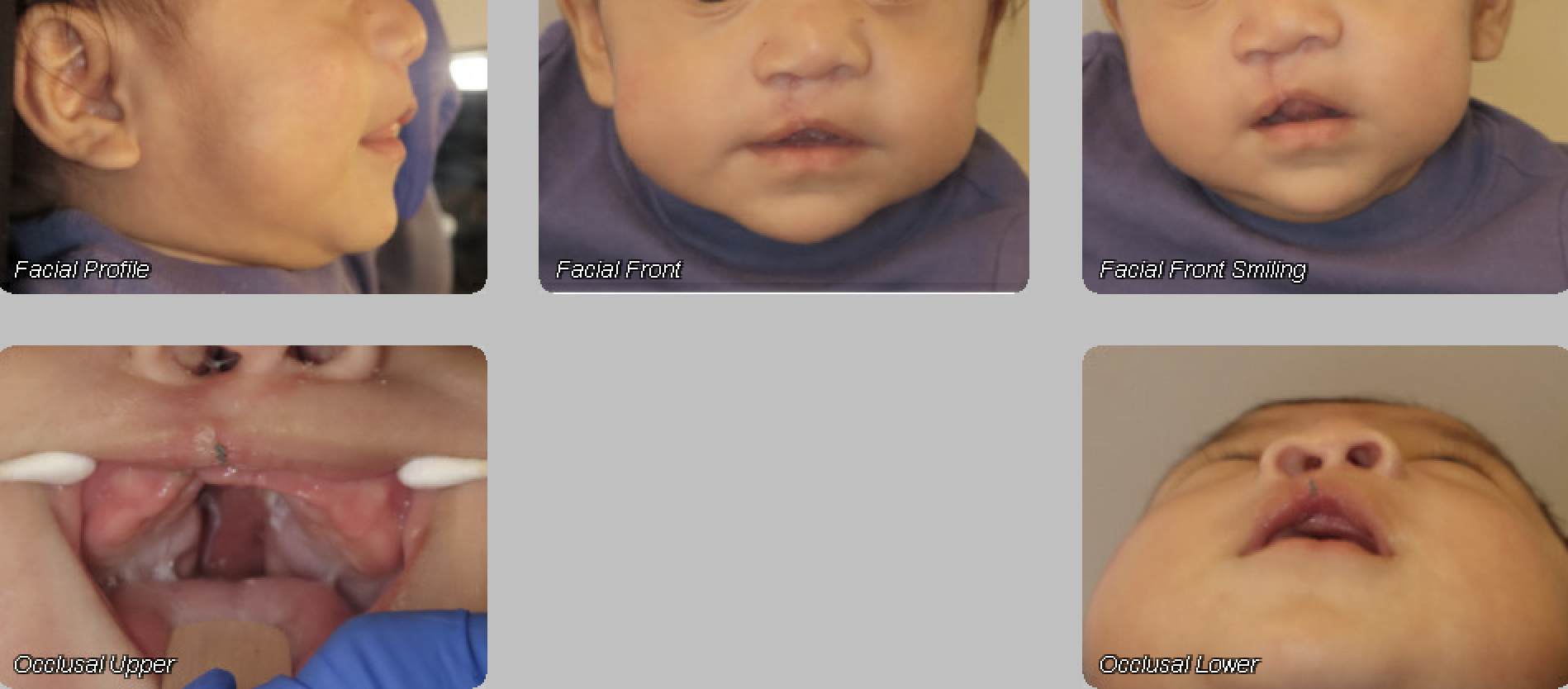Same cleft and craniofacial patient after NAM treatment — facial and intraoral views