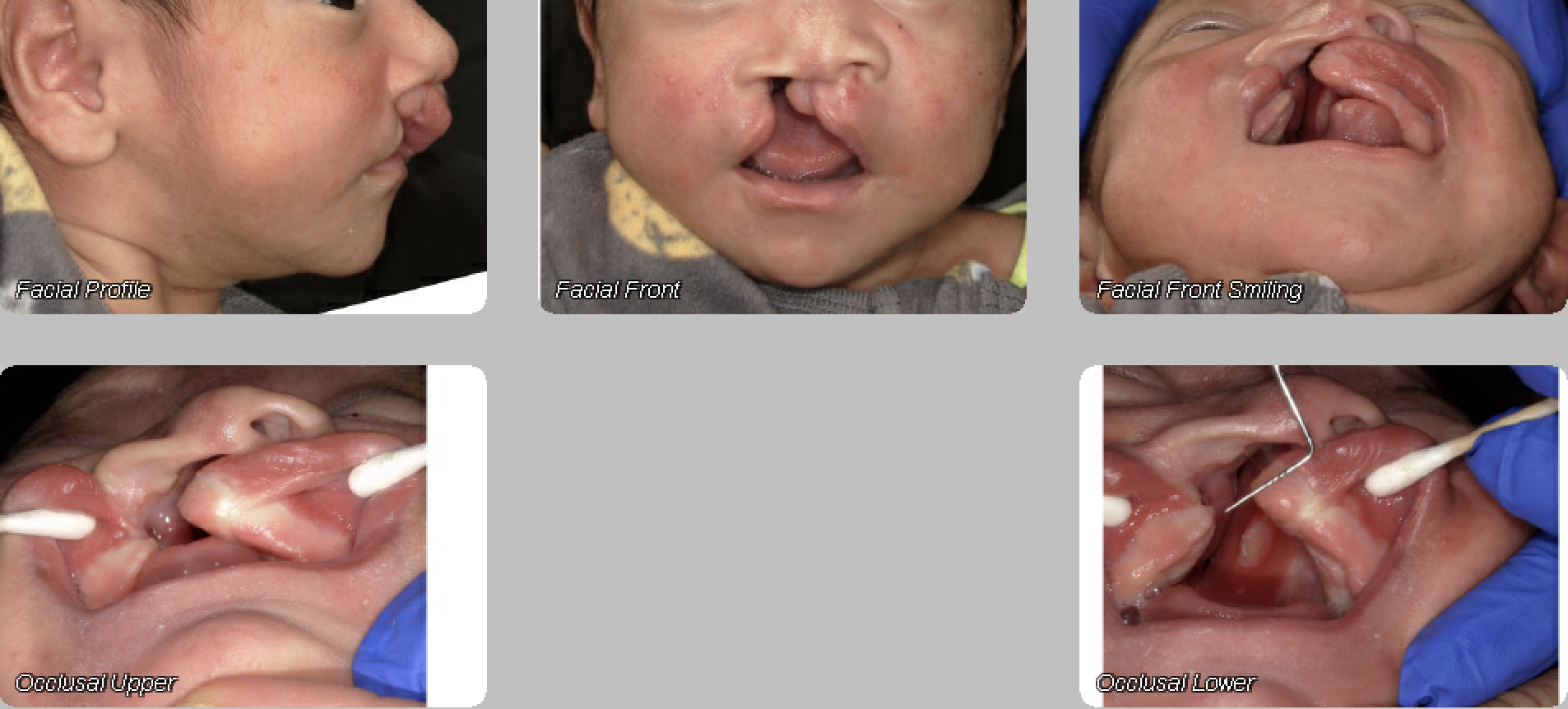 Cleft and craniofacial patient before NAM treatment — facial and intraoral views