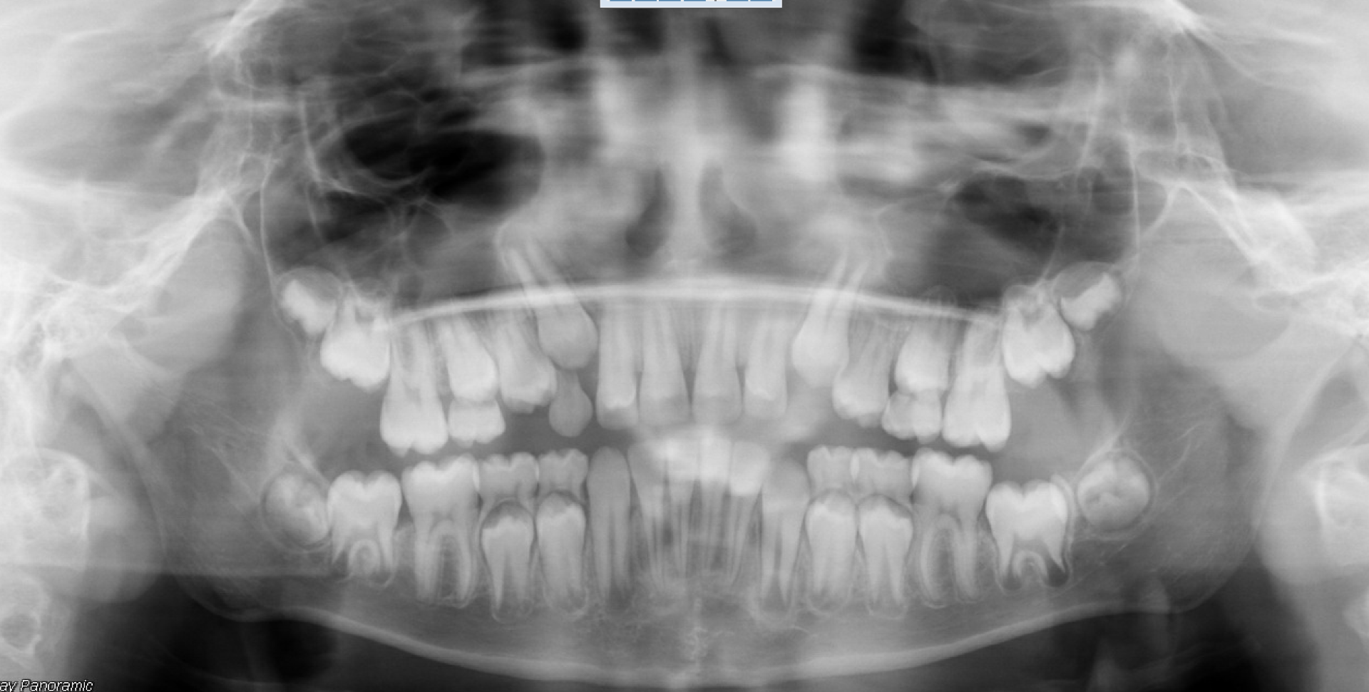 Case 02 — The perfect finish — set up for the adult teeth to erupt beautifully!